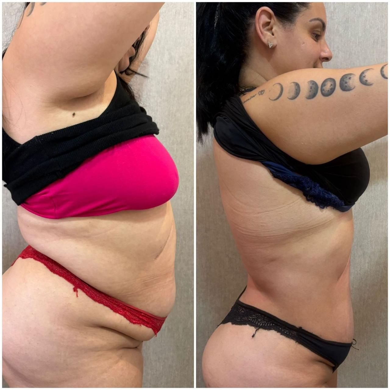 Cecília, antes e depois, perda de 14kg